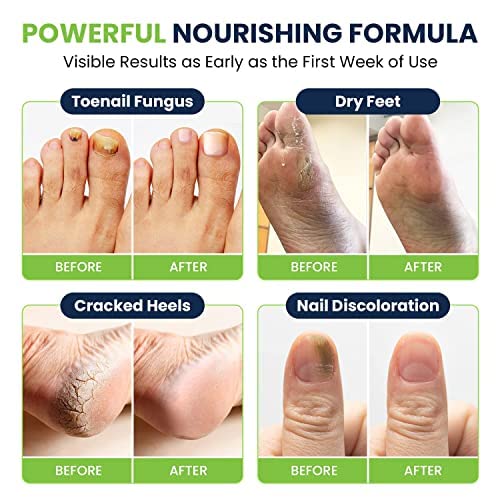 Toenail Fungus Treatment Extra Strength - Image 4