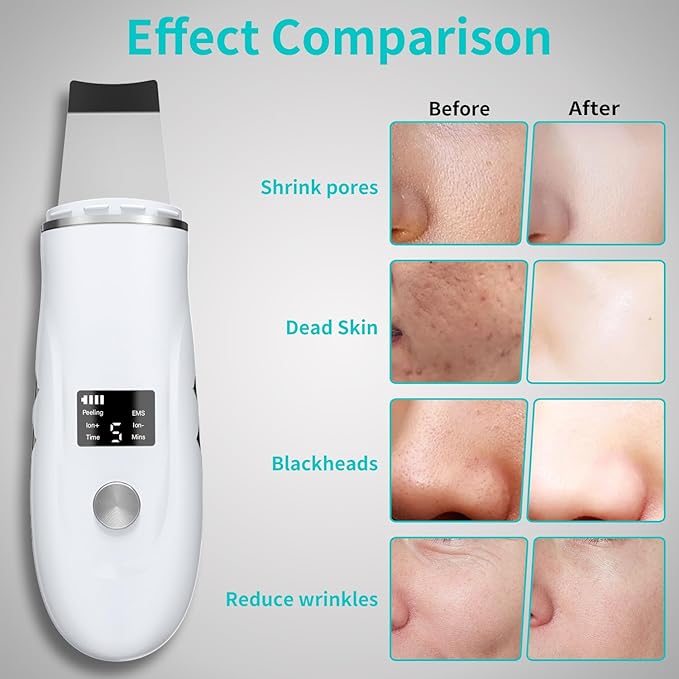 Face Spatula Blackhead Remover - Image 3