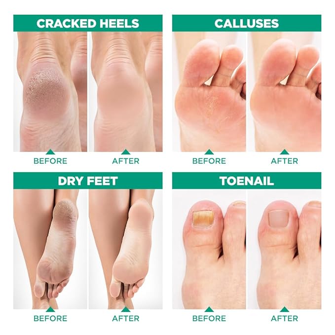 Tea Tree Oil Foot Soak with Epsom Salt - Image 5