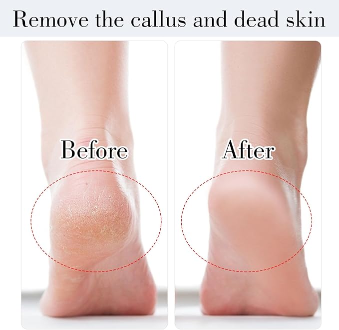 JIEYAO Stainless Steel Foot File, Metal Foot Scraper, Professional Foot File - Image 4
