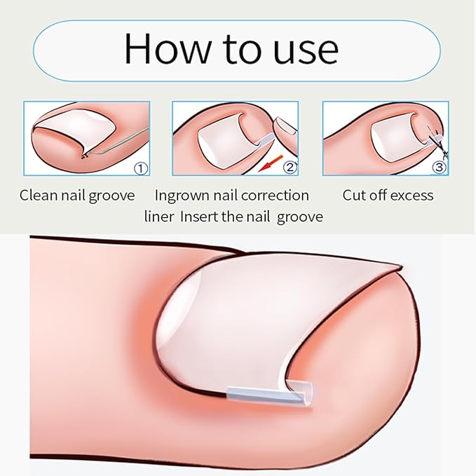 Professional Ingrown Toenail Correction Kit - Image 8
