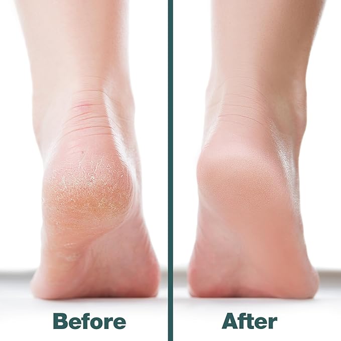 Probelle Double Sided Multidirectional Nickel Foot File Callus Remover - Image 5