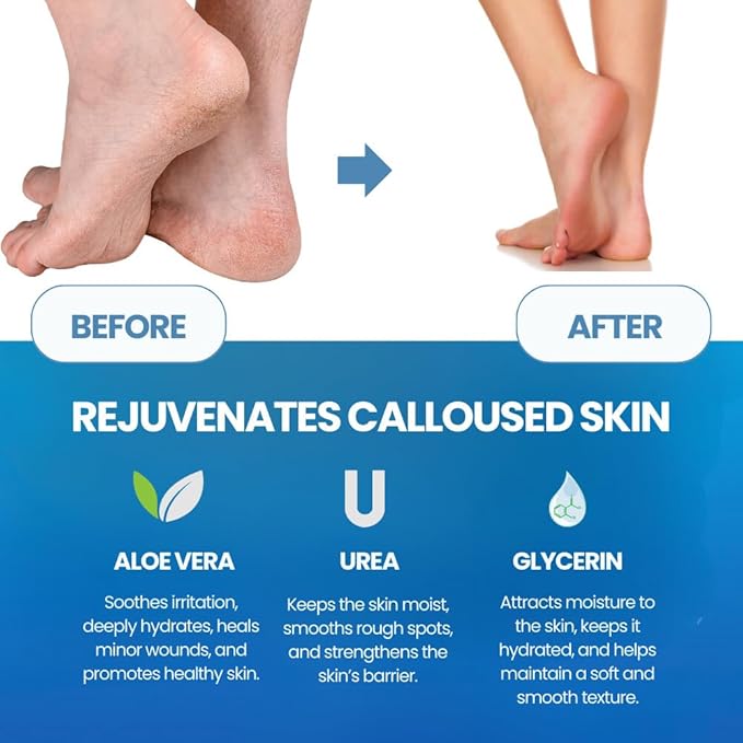 Imperial Feet Callus Remover for Feet Extra Strength Set – Callus Softener - Image 5