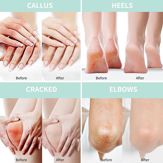 Urea Cream 20 Percent For Feet Plus 2% Salicylic Acid 150g || Foot Cream and - Image 3