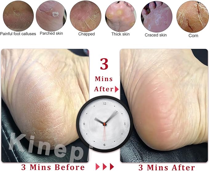 Kinepi Callus Remover Foot Scrubber Colossal Foot File Foot Care and Foot - Image 4