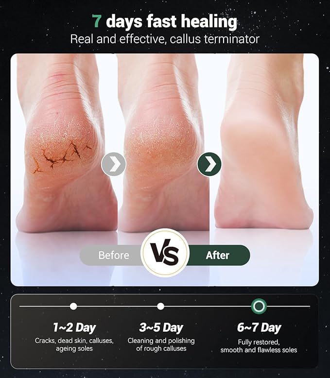 5-in-1 Professional Electric Callus Remover, Removes 99.92% of Calluses in 3 - Image 5