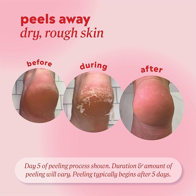 Onyx Professional Foot Peel Mask Callus Remover, 2 pack - Image 4