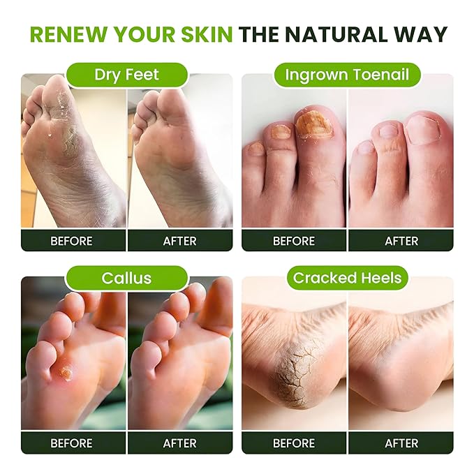 FOOT CURE Tea Tree Oil Foot Soak - Image 4