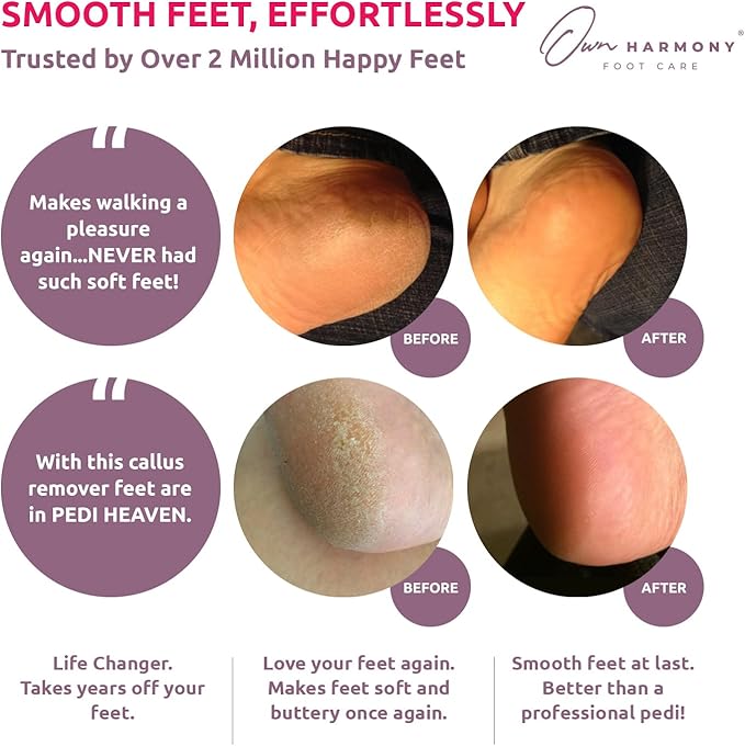 Electric Callus Remover for Feet: Professional Foot Care for Women by Own - Image 2