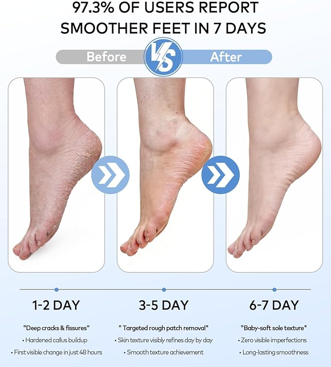Rechargeable Electric Callus Remover - Image 5