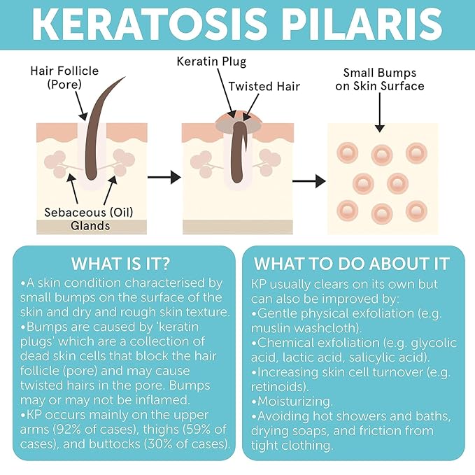 KP Bump Eraser Body Set with 10% AHA | Keratosis Pilaris Treatment | Keratosis - Image 6