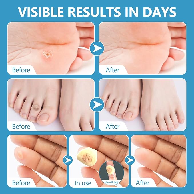 Corn removers for Toes feet Bottom of Foot Corn Remover, Corn Pads Remover for - Image 4