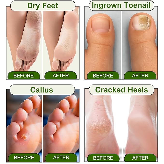 Epsom Salt Foot Soak, Dead Sea Salt Spa Pedicure Care Softens Thick Calluses & - Image 4