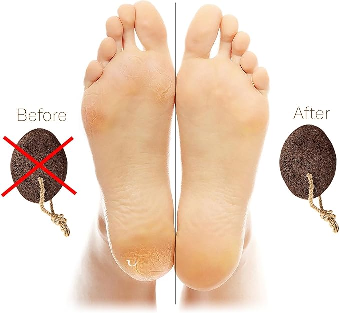 Pumice Stones for Feet - Image 5