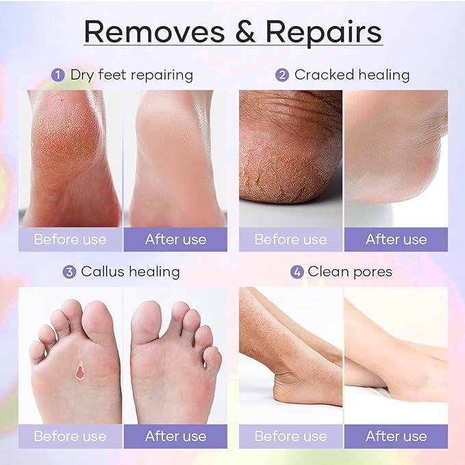 Deluxe Pedicure Kit 5 Step Spa Set – Epsom Salt Soak, Callus Remover Gel - Image 6
