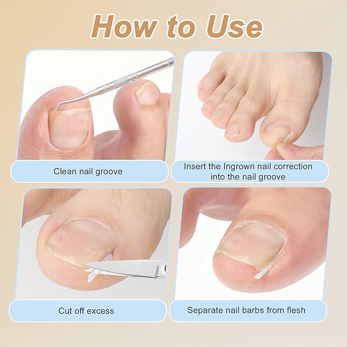 VOCOSTE Ingrown Toenail Correction Kit, Toe Nail Corrector Tools - Image 3