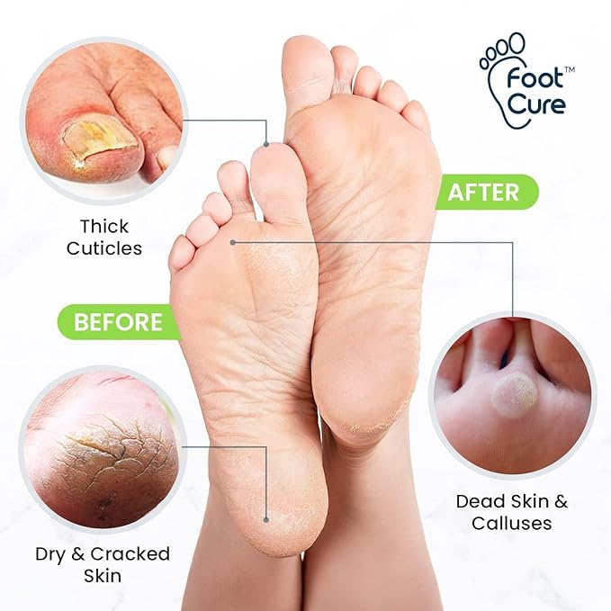 FOOT CURE Exfoliator & Callus Remover Pedicure Set – Care Kit Includes File - Image 8