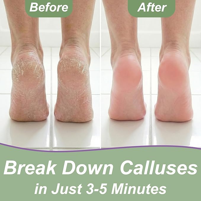 Callus Remover for Feet Foot Callus Remover Gel, Spa Foot Care, Pedicure Tools - Image 4
