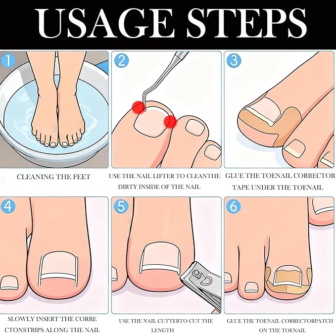Ingrown Toenail Corrector Set - Image 2