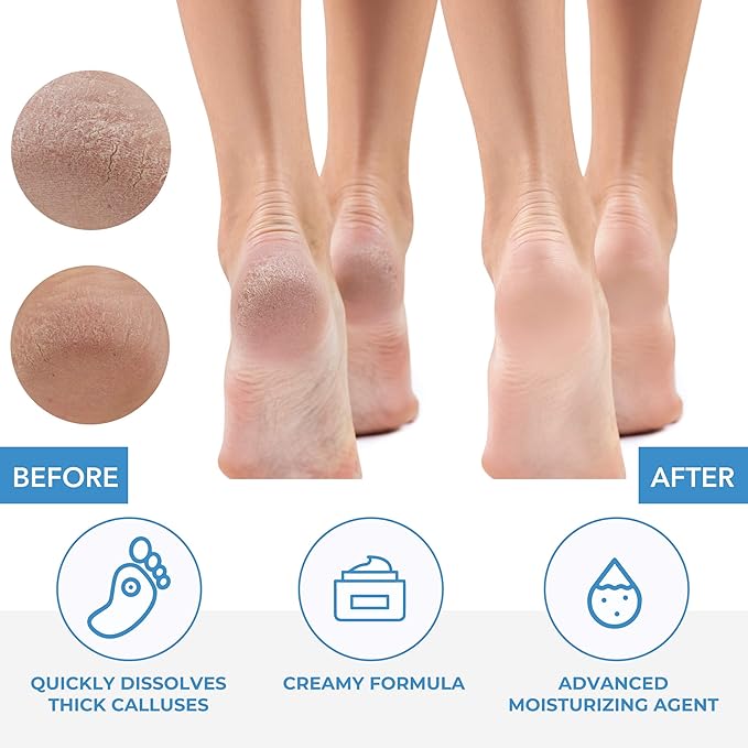 ForPro Professional Collection Premium Callus No More! Callus Remover, - Image 5
