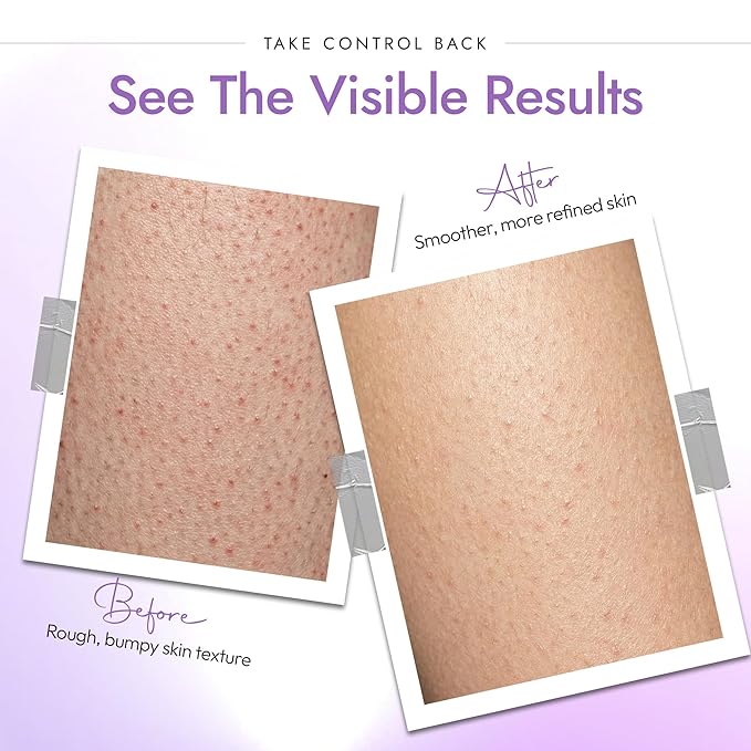 DERMAdoctor KP Bump Eraser Body Scrub - Image 3