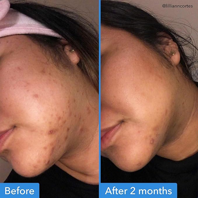 Good Molecules Discoloration Correcting Serum Pack 3 – 30 ml Each | Tranexamic - Image 3