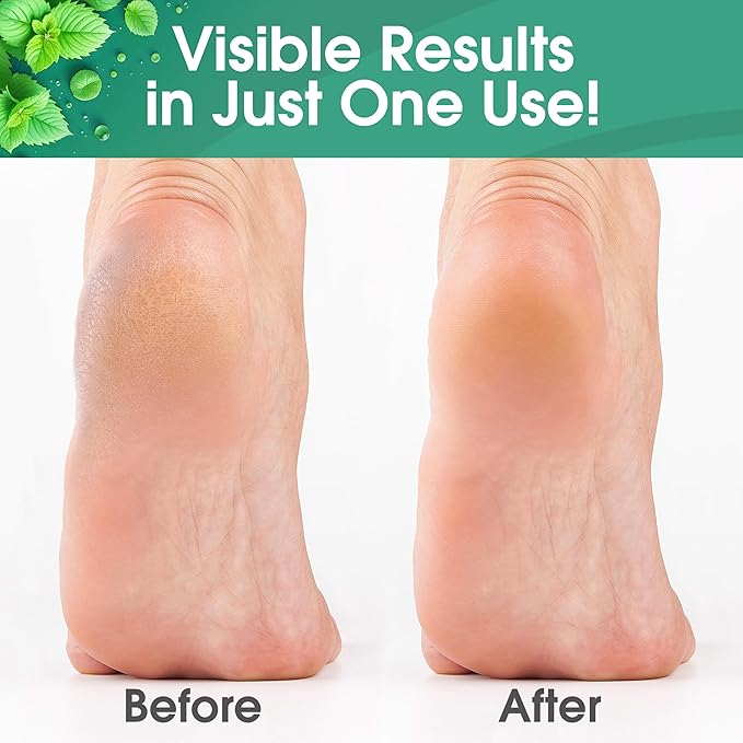 DeEnti Callus Remover for Feet, Extra Strength Foot Callus Remover Gel - Image 3