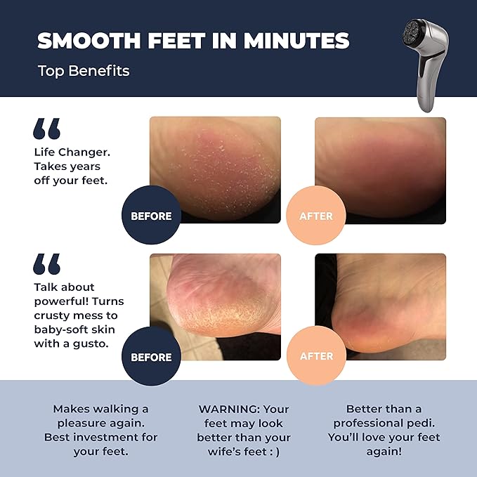 Electric Foot Callus Remover - Image 3